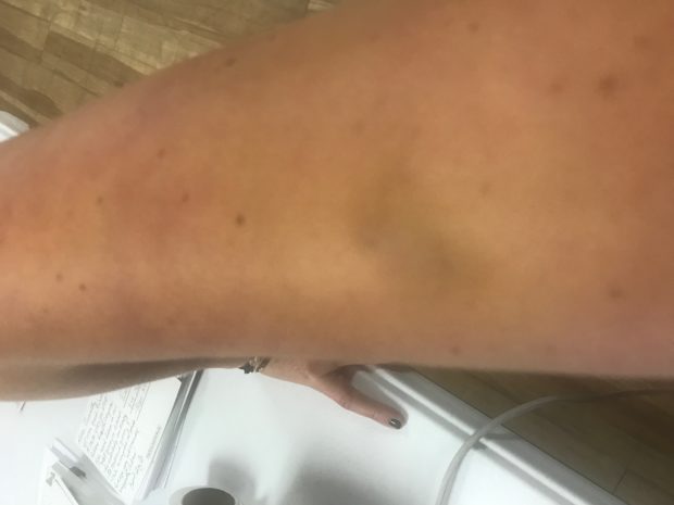 Kristin Davison bruised arm (Photo obtained by TheDCNF)