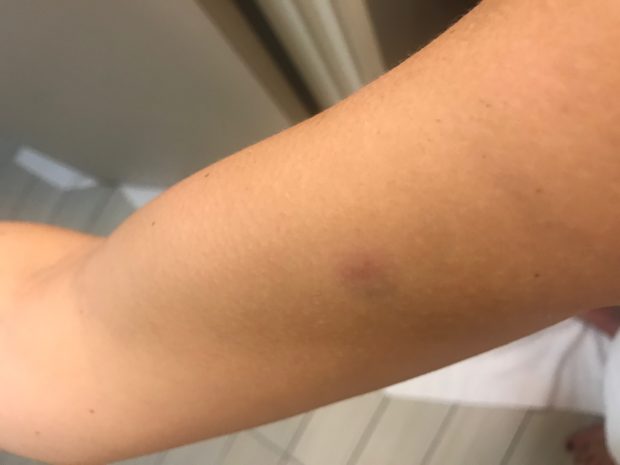 Kristin Davison bruised arm (Photo obtained by TheDCNF)Kristin Davison bruised arm (Photo obtained by TheDCNF)