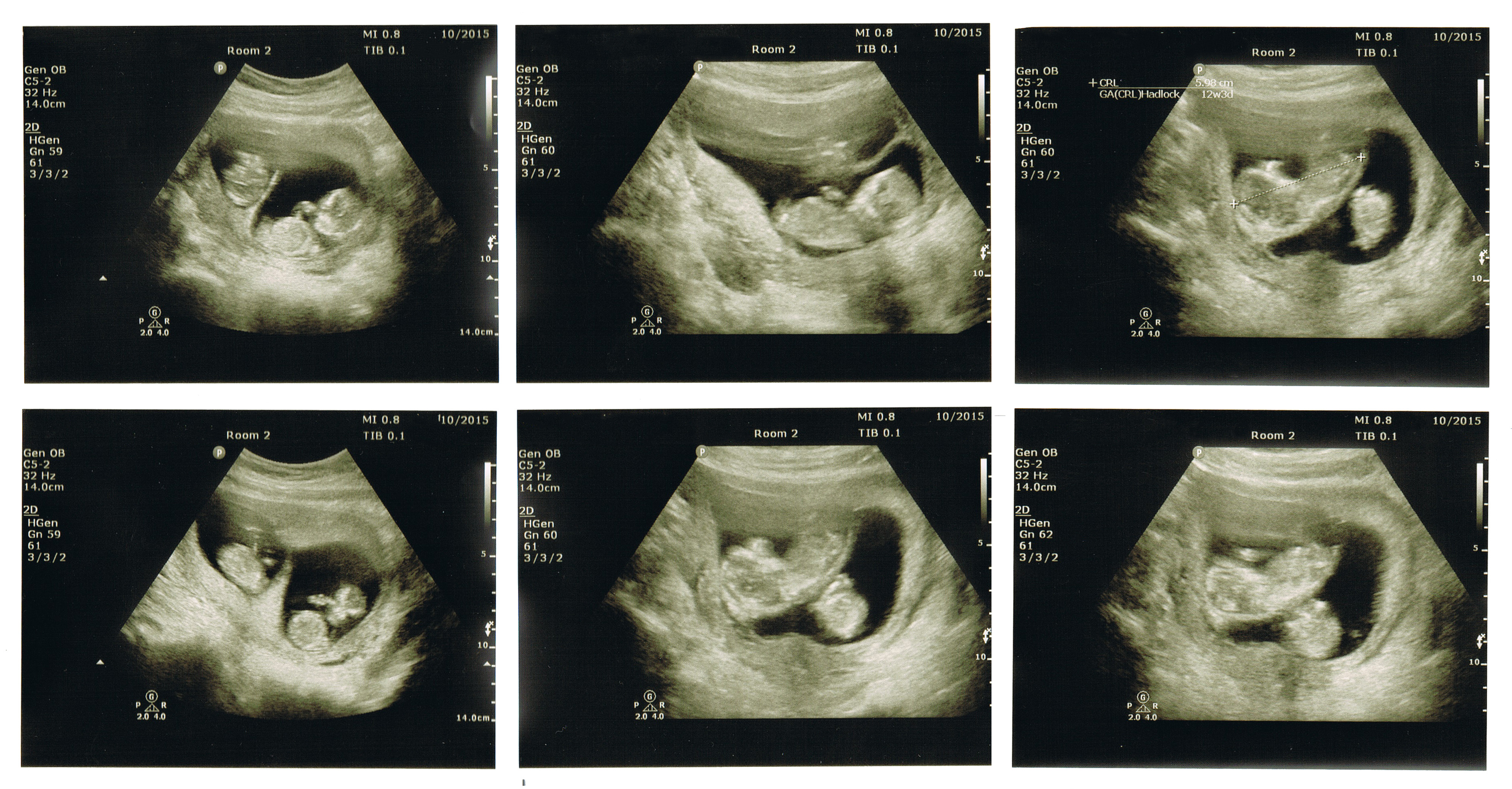 12 недель беременности что есть. Разнояйцевые Близнецы 12 недель УЗИ. Как выглядит двойня на УЗИ В 12 недель. УЗИ двойни на 12 неделе беременности фото. Многоплодная беременность 12 недель УЗИ скрининг.