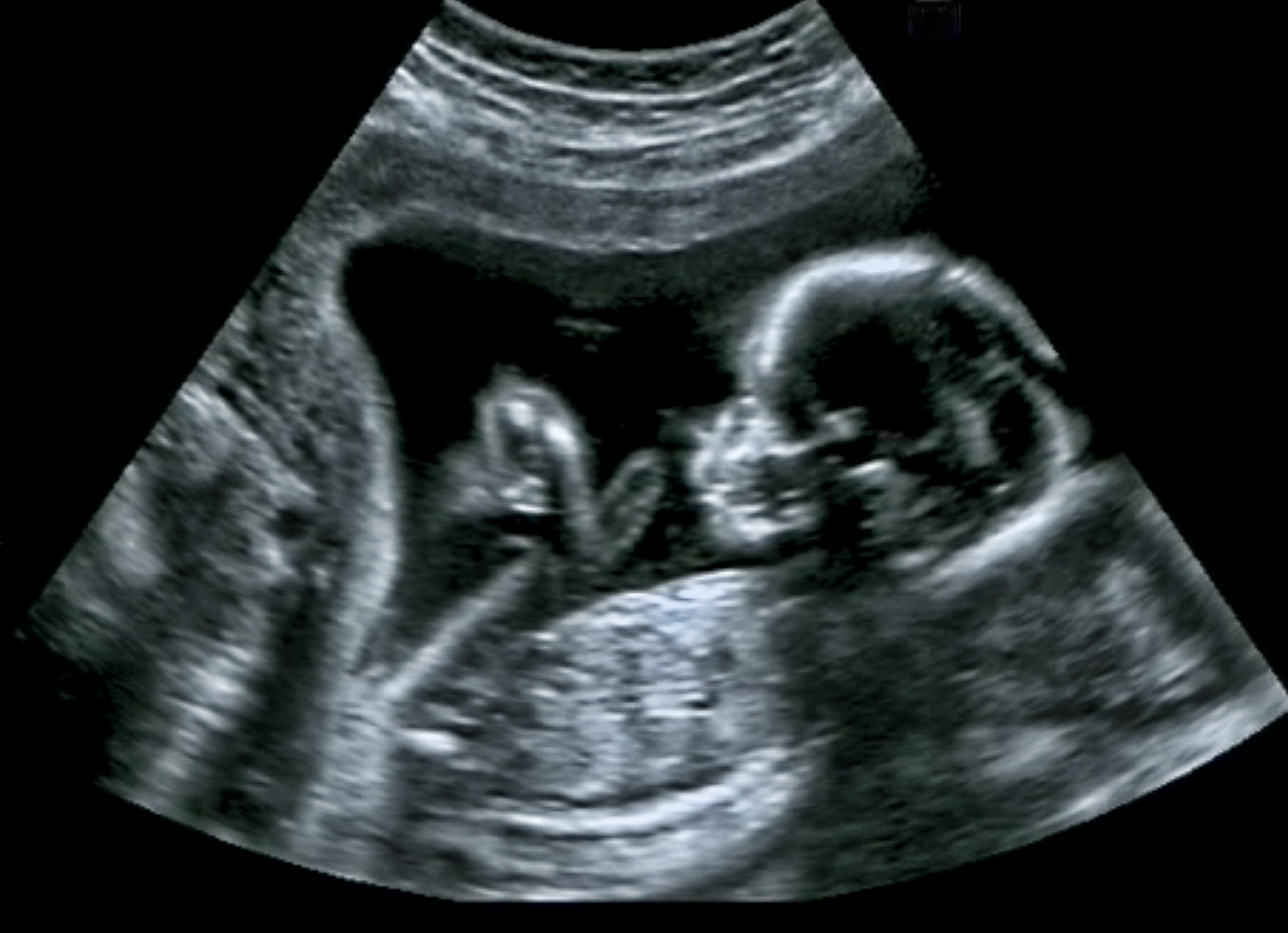 Pictured is an ultrasound of a fetus. SHUTTERSTOCK/ GagliardiImages