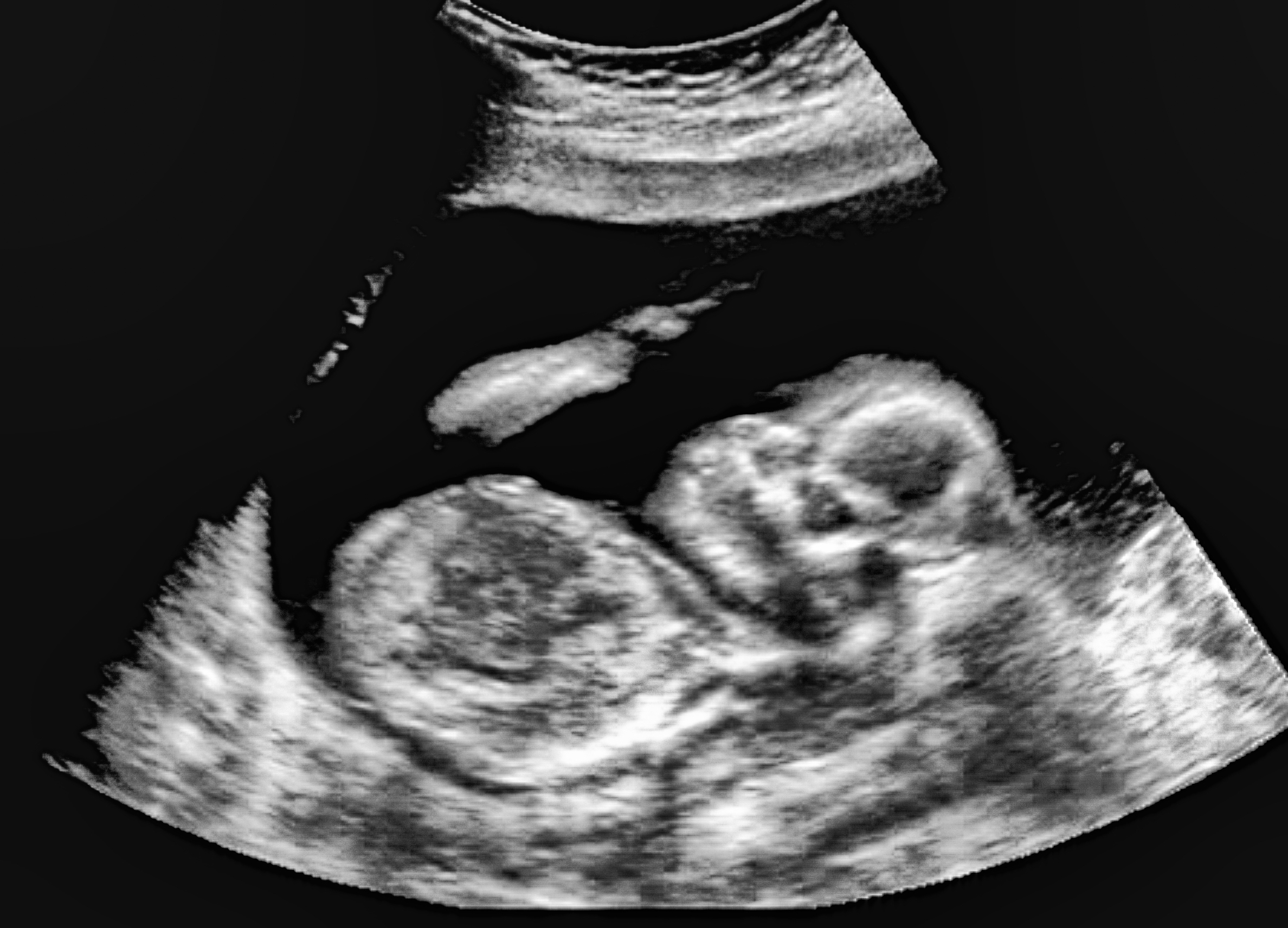 An ultrasound of a human fetus during the 16th week. GagliardiPhotography, Shutterstock. 